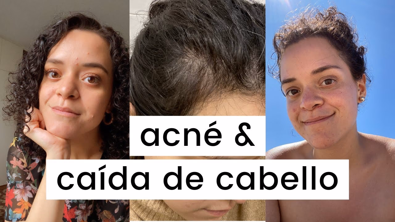 ¿Por qué tengo acné y caída del cabello?