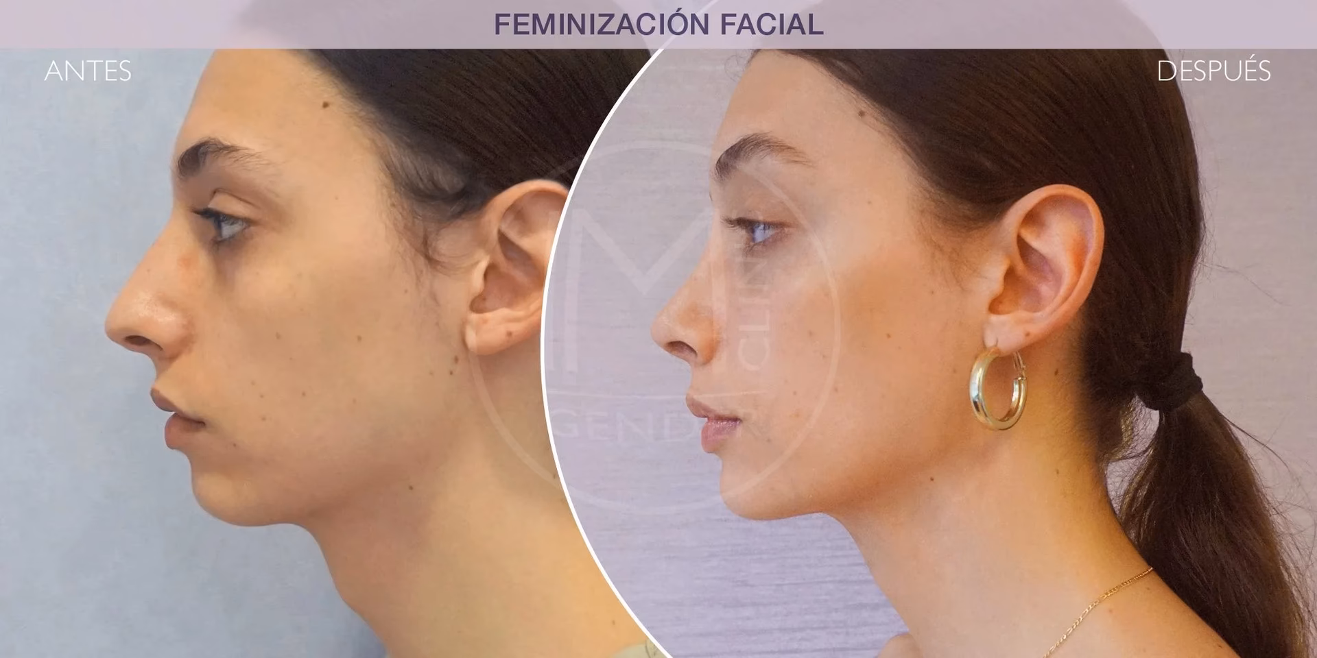 ¿La línea del cabello retrocede después del trasplante?