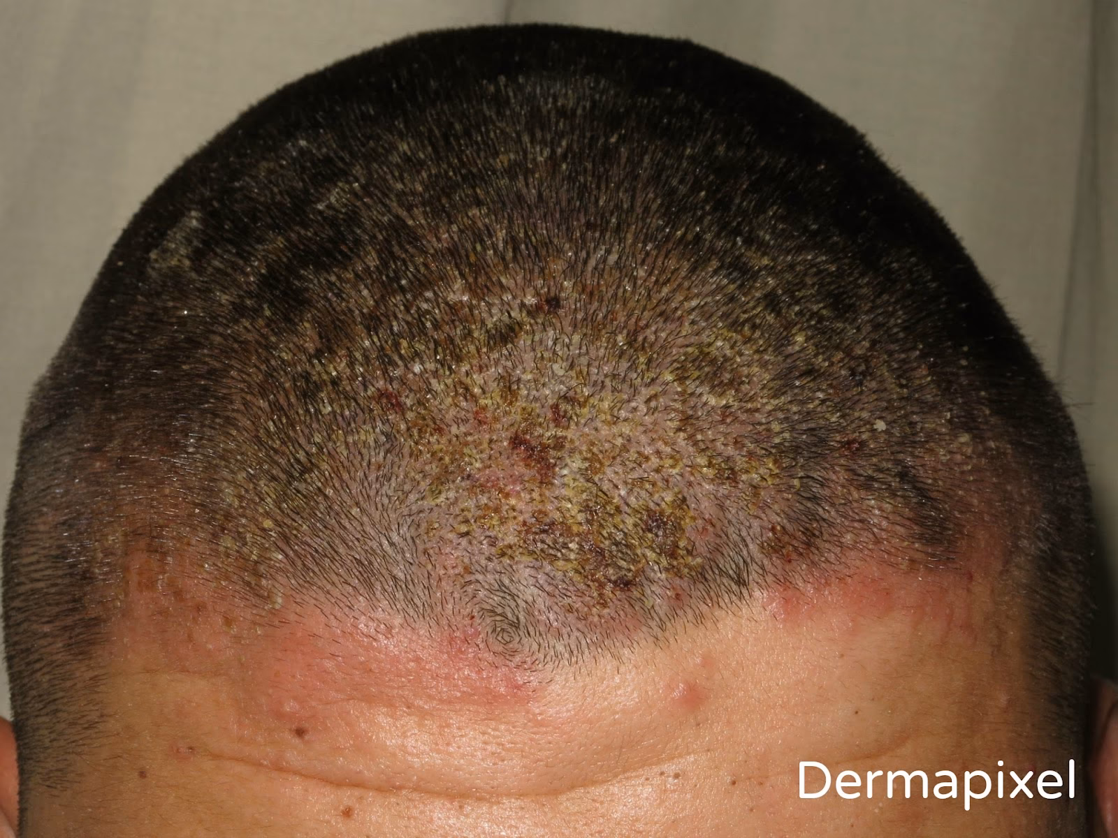 ¿Cómo se quita la alergia por contacto?