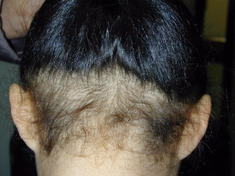 ¿Cuánto tiempo dura la alopecia difusa?