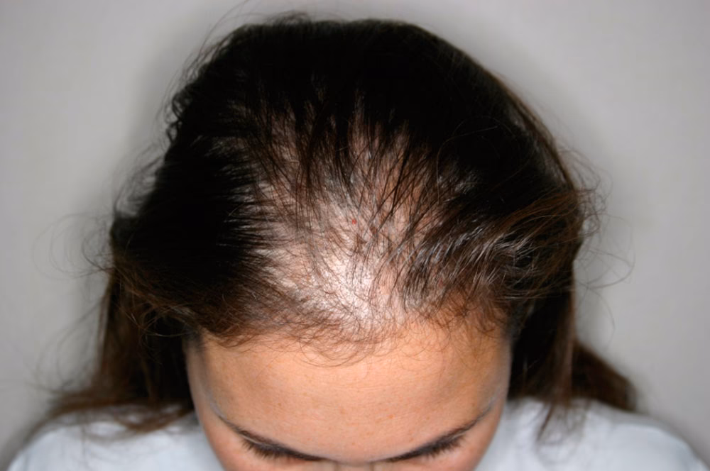 ¿Qué puede provocar alopecia en mujeres?