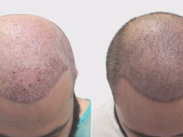 ¿Qué pasa si no tomo finasteride después de trasplante capilar?