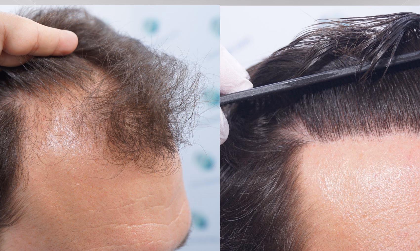 ¿Qué tomar para la caída del cabello Dr. Simi?