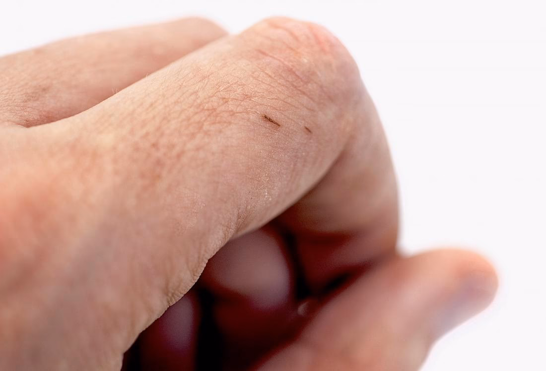 ¿Qué pasa si tengo una astilla y no la puedo sacar?