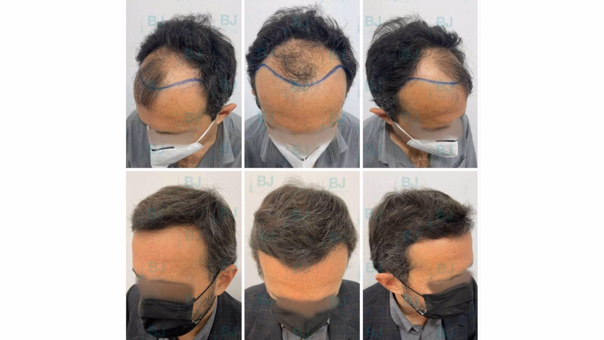 ¿Cuánto tiempo tarda en ver resultados del plasma en el cabello?