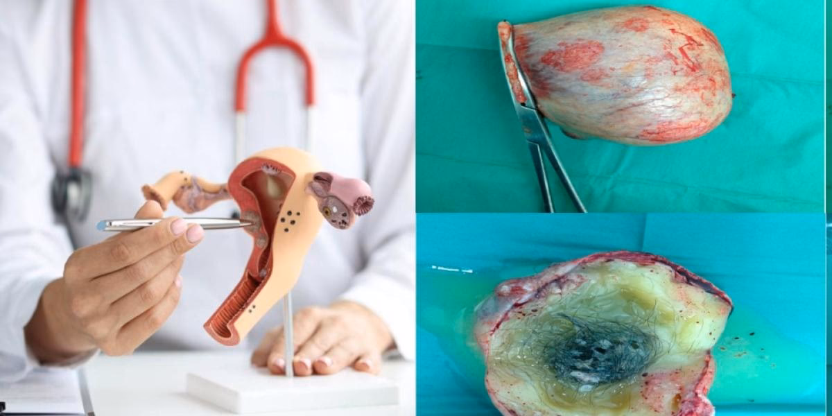 ¿Cómo saber si es quiste o teratoma?