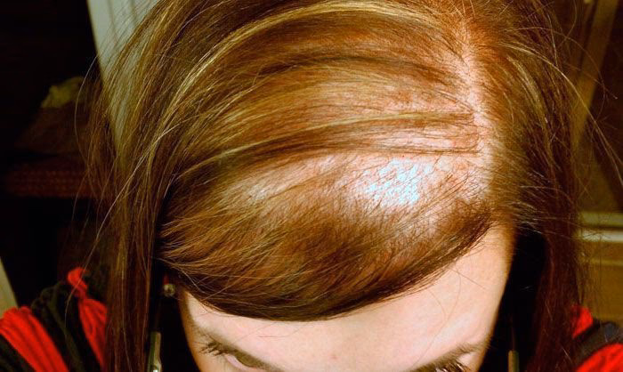 ¿Cuáles son las consecuencias del vómito provocado?