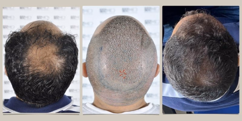 ¿Cómo puedo recuperar el cabello de la coronilla?