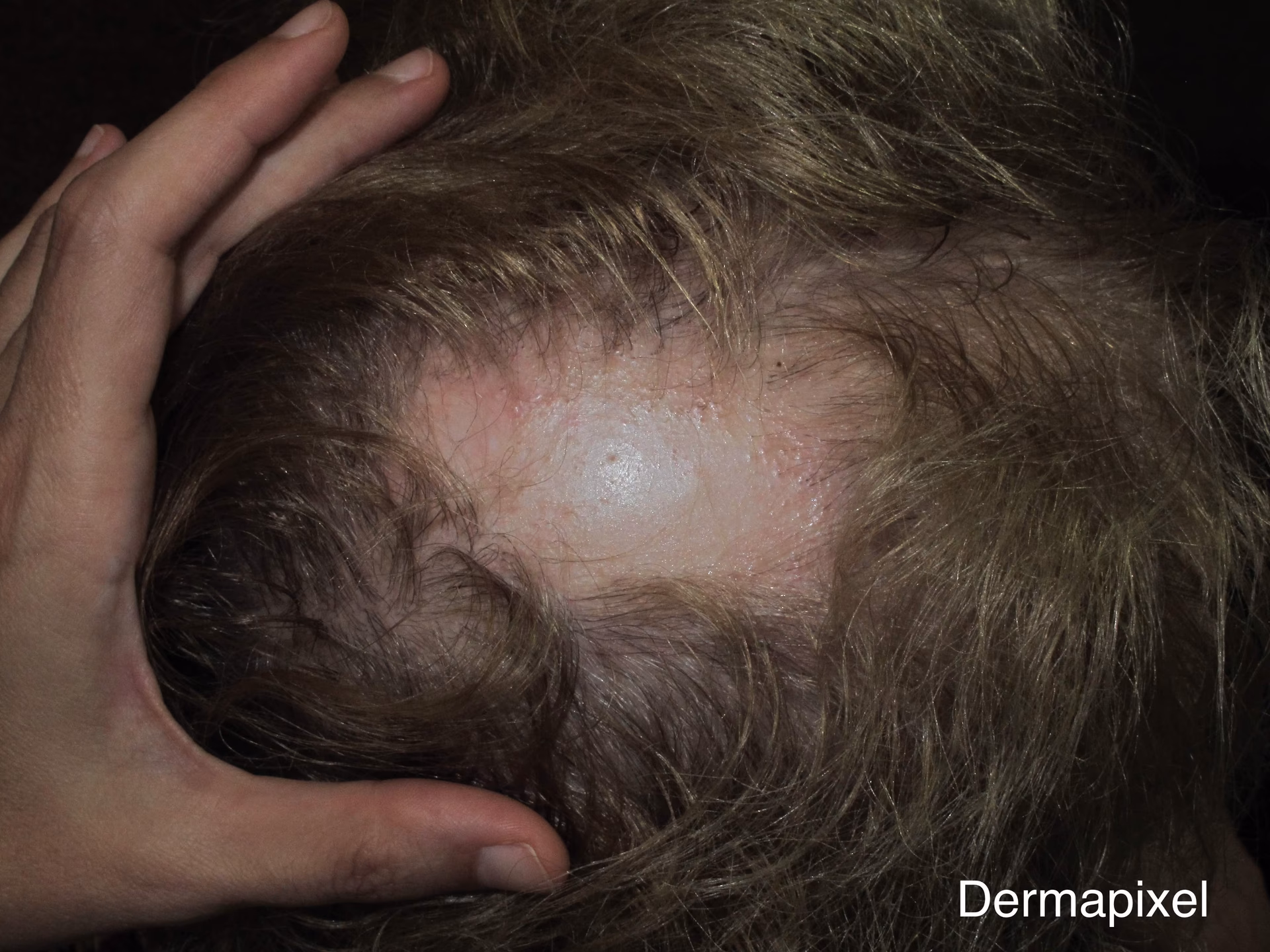 ¿Cómo es el lupus en el cabello?