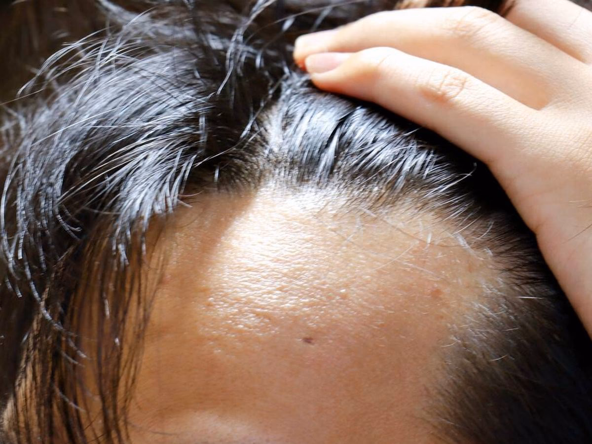 ¿La obesidad provoca la caída del cabello?