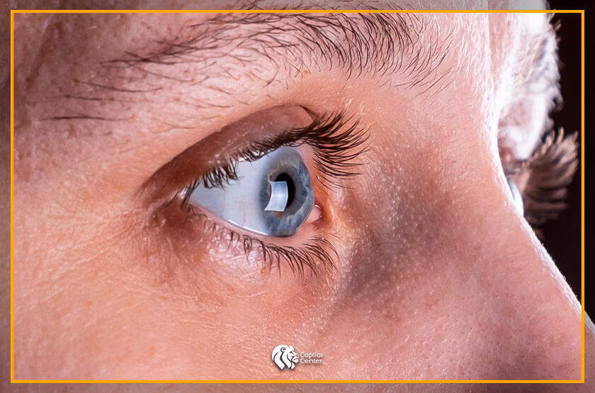 ¿Puede el hipotiroidismo provocar la pérdida de las cejas?