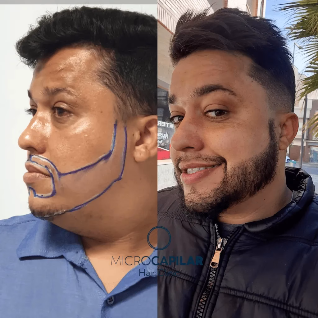 ¿Cuántos folículos necesito para la barba?