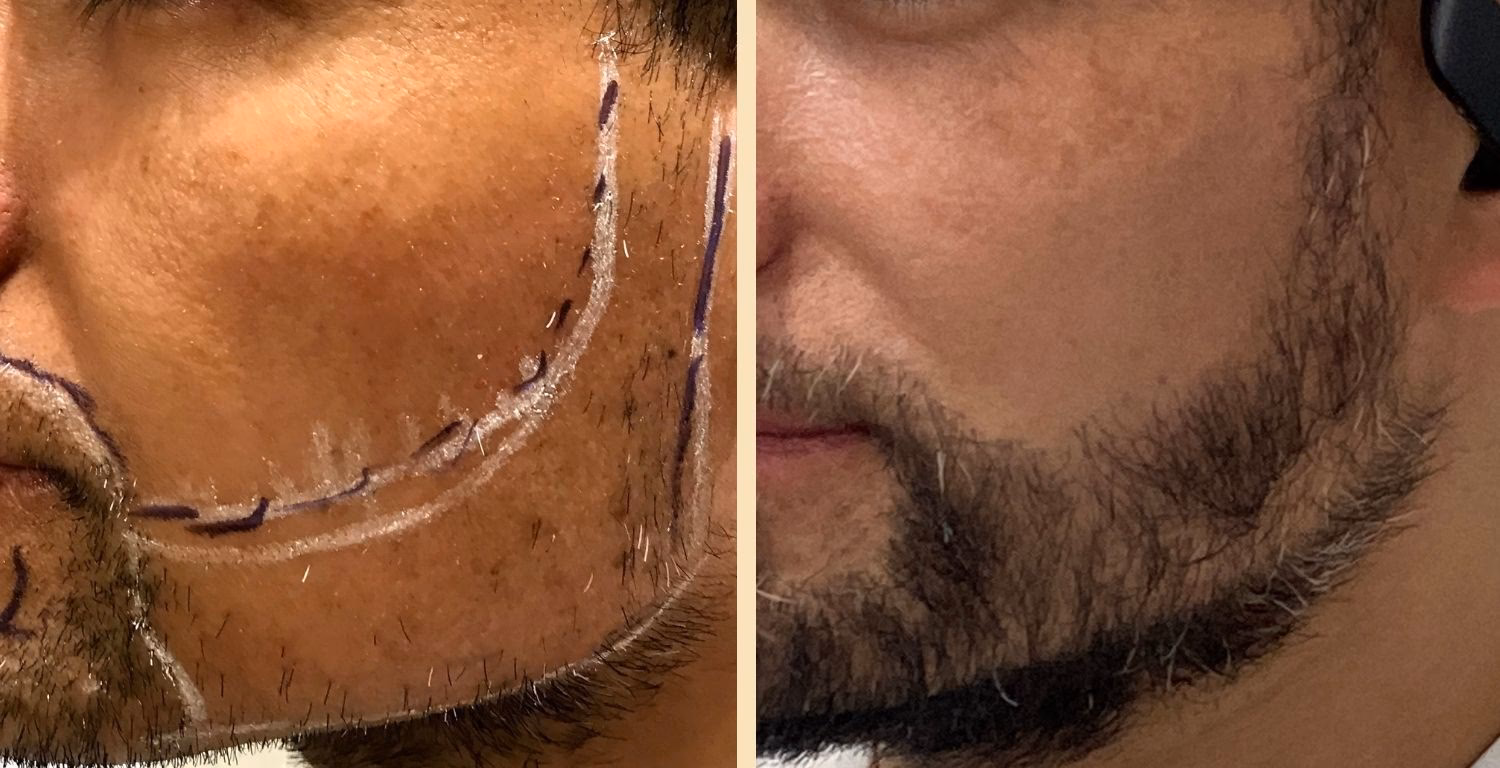 ¿Cuánto cuesta un trasplante capilar de barba?
