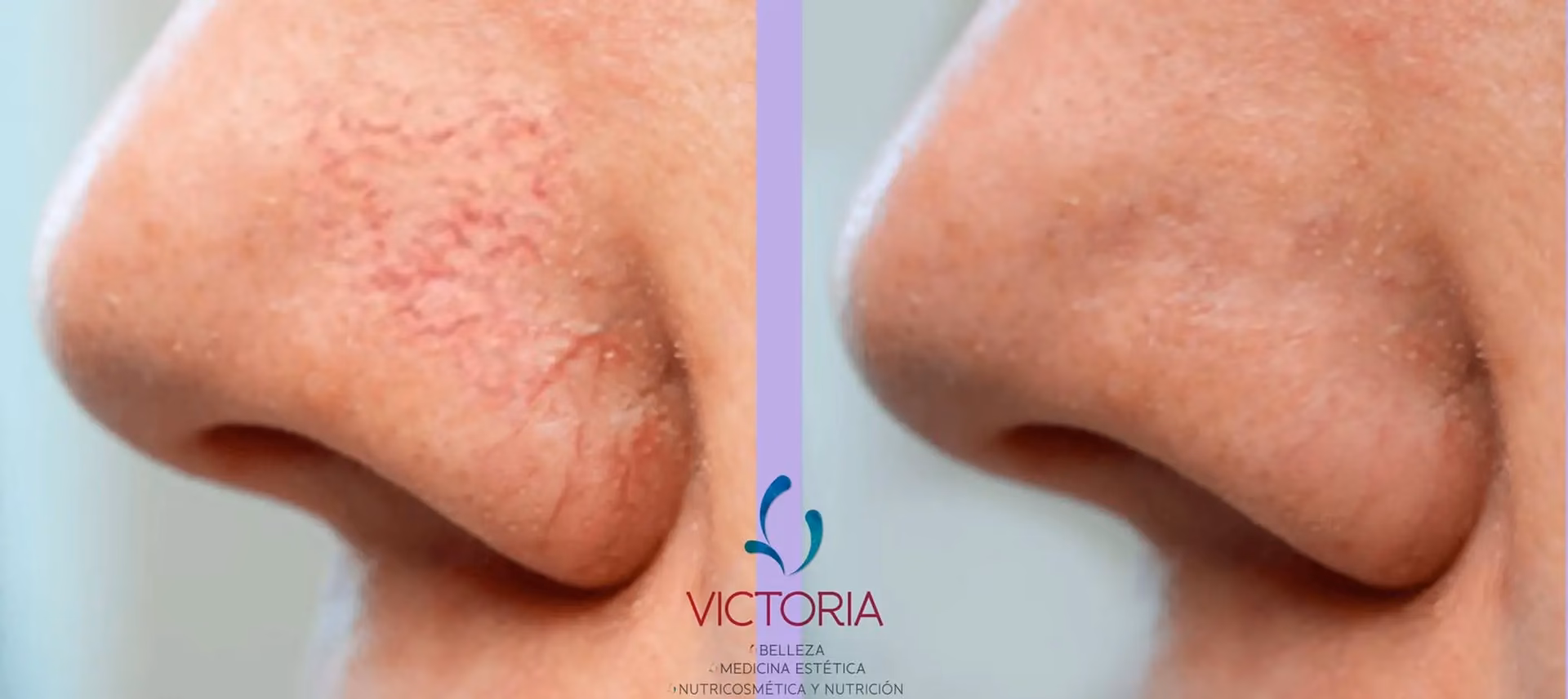 ¿Cómo queda la piel después del láser vascular?