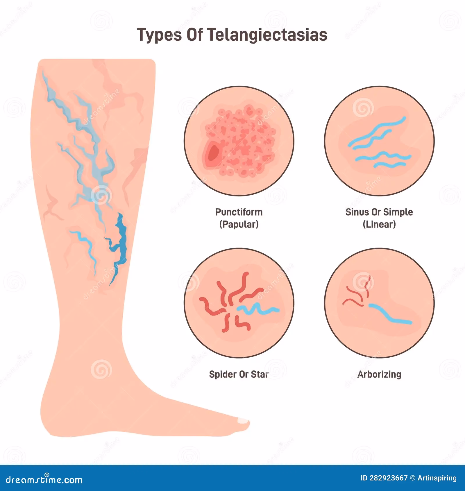 ¿Qué es un capilar dilatado?