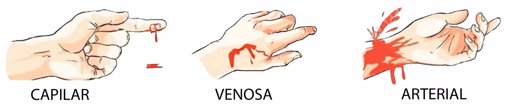 ¿Cuáles son las características de la hemorragia capilar?