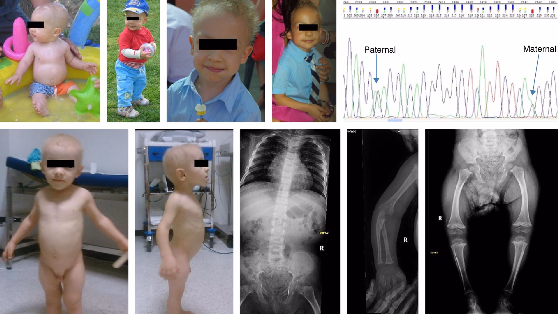 ¿Qué es la hipoplasia del cartílago piloso?