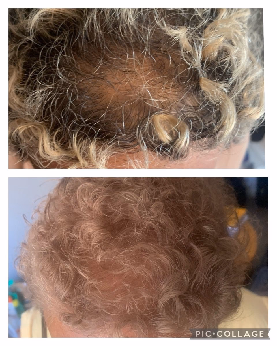 ¿Cuánto cuesta un trasplante de cabello con células madre?