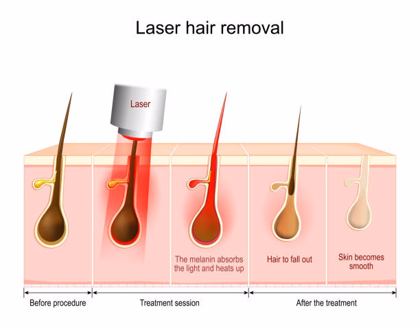 ¿Cuál es el mejor tipo de cabello para la depilación láser?