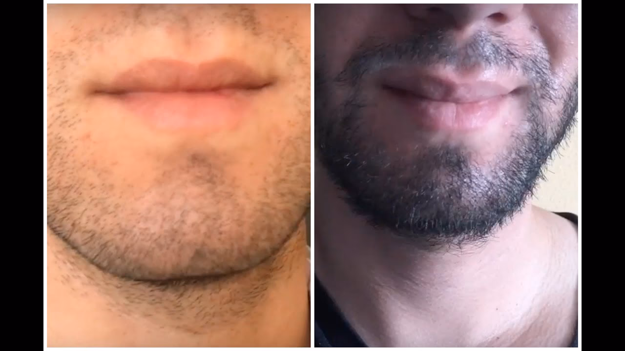 ¿Es posible realmente aumentar el grosor de la barba?