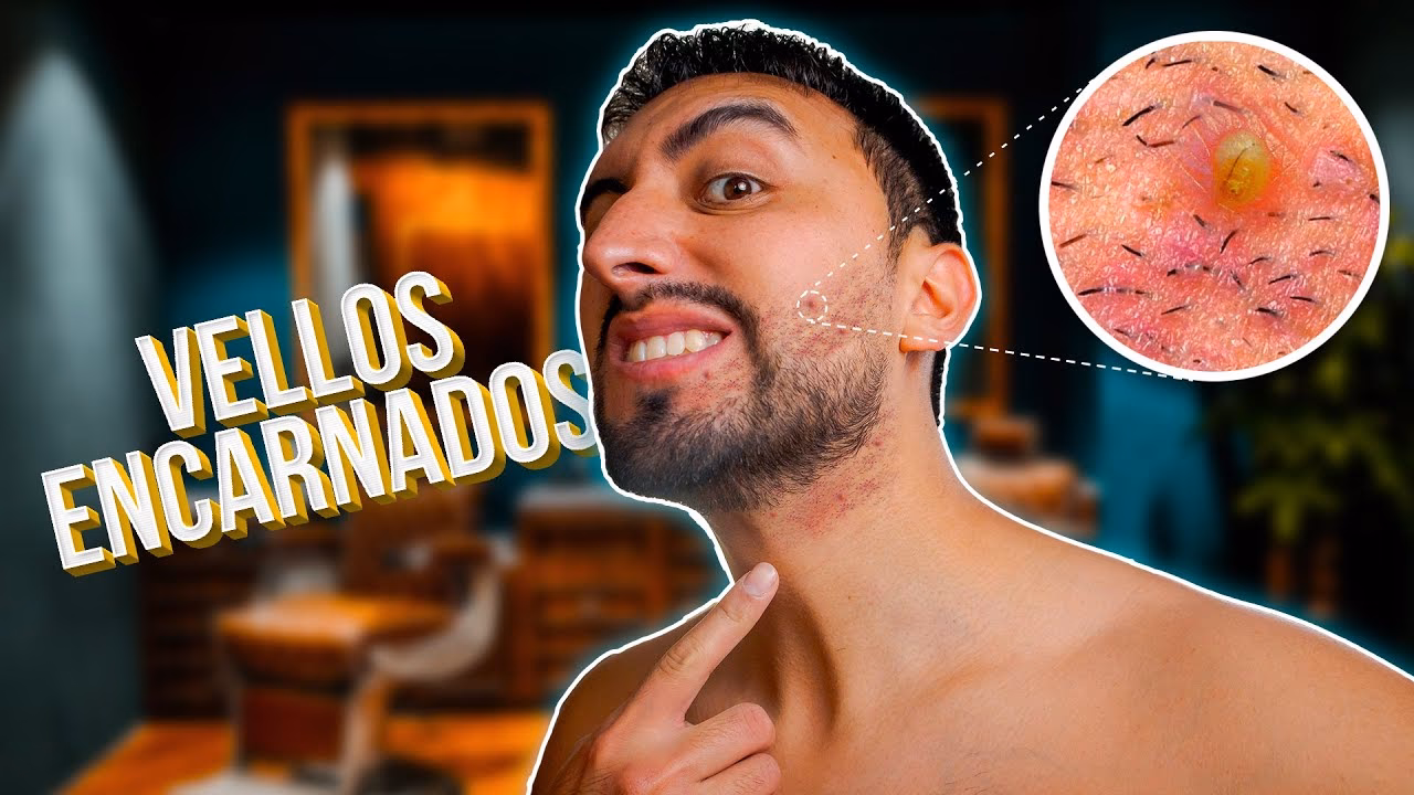 ¿Cómo quitar pelos encarnados de la barba?
