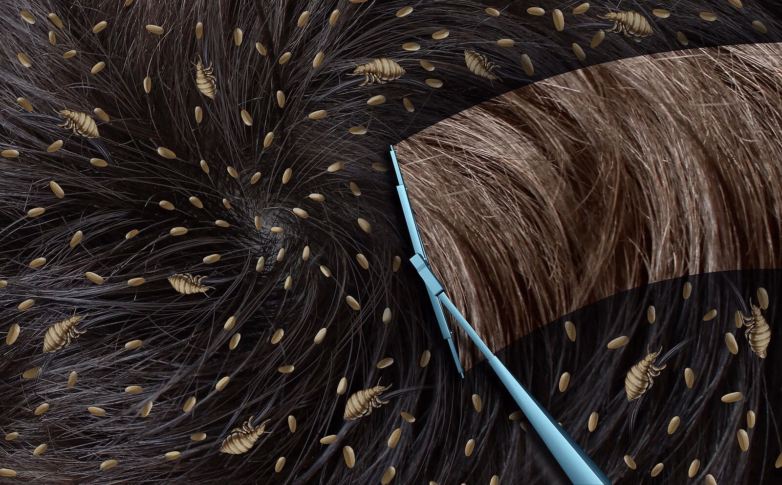 ¿Cómo deshacerse de los huevos de piojos en el cabello durante la noche?