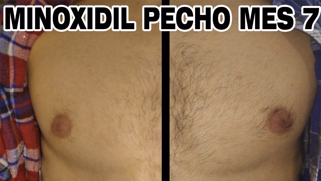 ¿Qué hacer para que me crezca mi pecho?