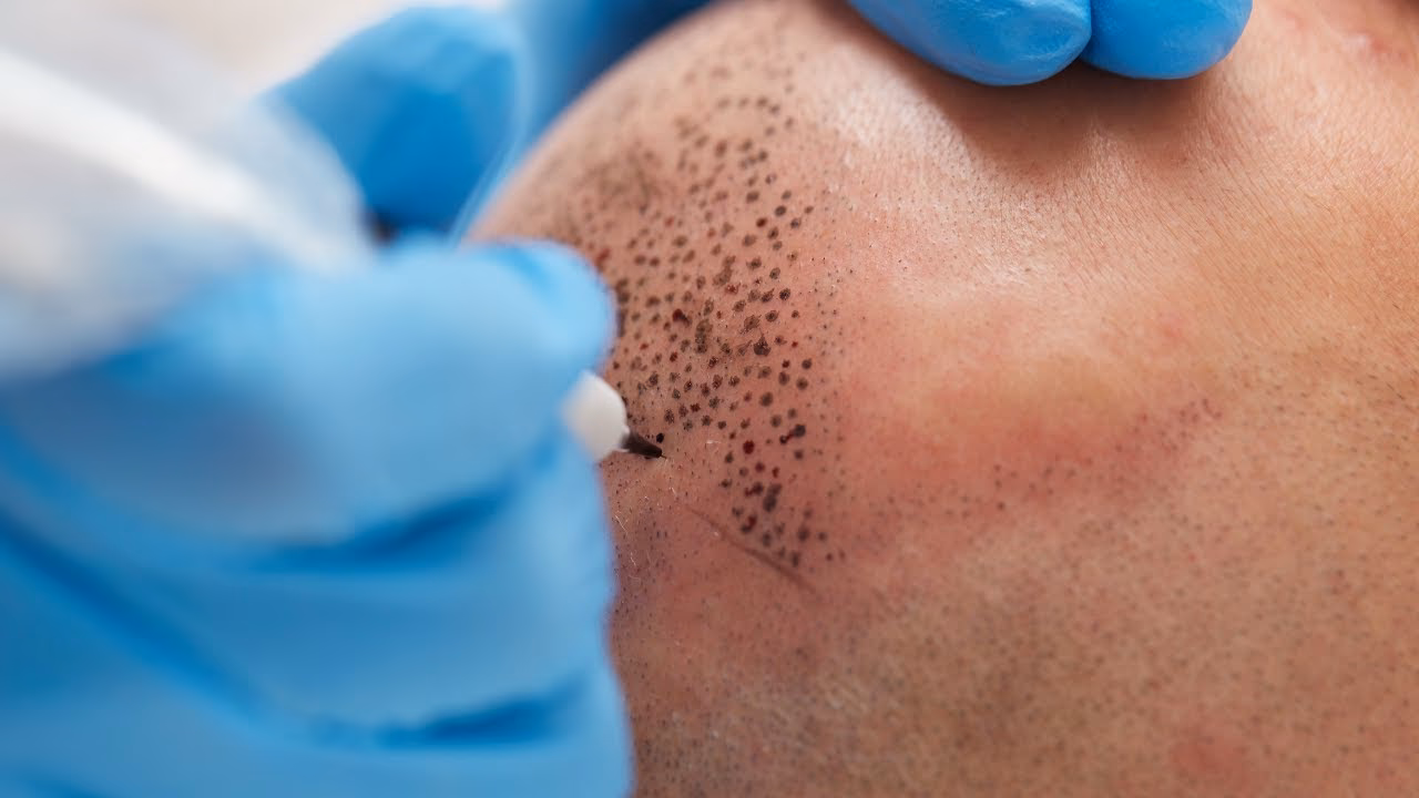 ¿Qué necesito para hacer micropigmentación?