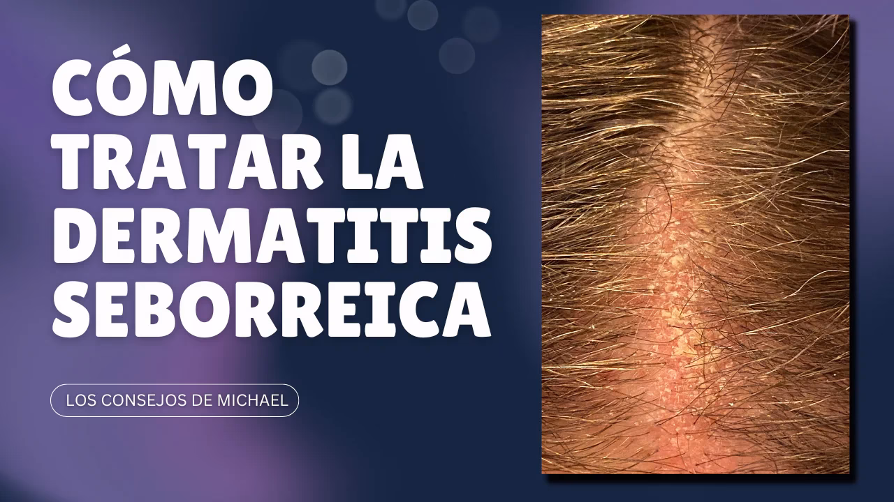 ¿Cómo lavar el pelo con dermatitis seborreica?