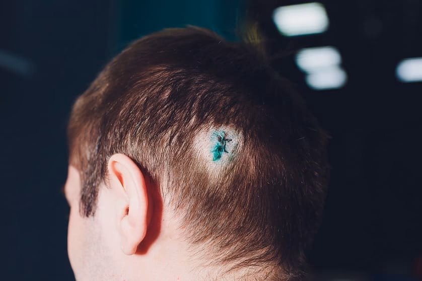 ¿Cómo tapar una cicatriz en el pelo?