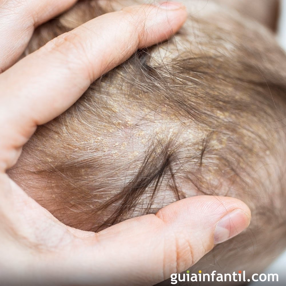 ¿Qué pasa si le quito la costra láctea a mi bebé?