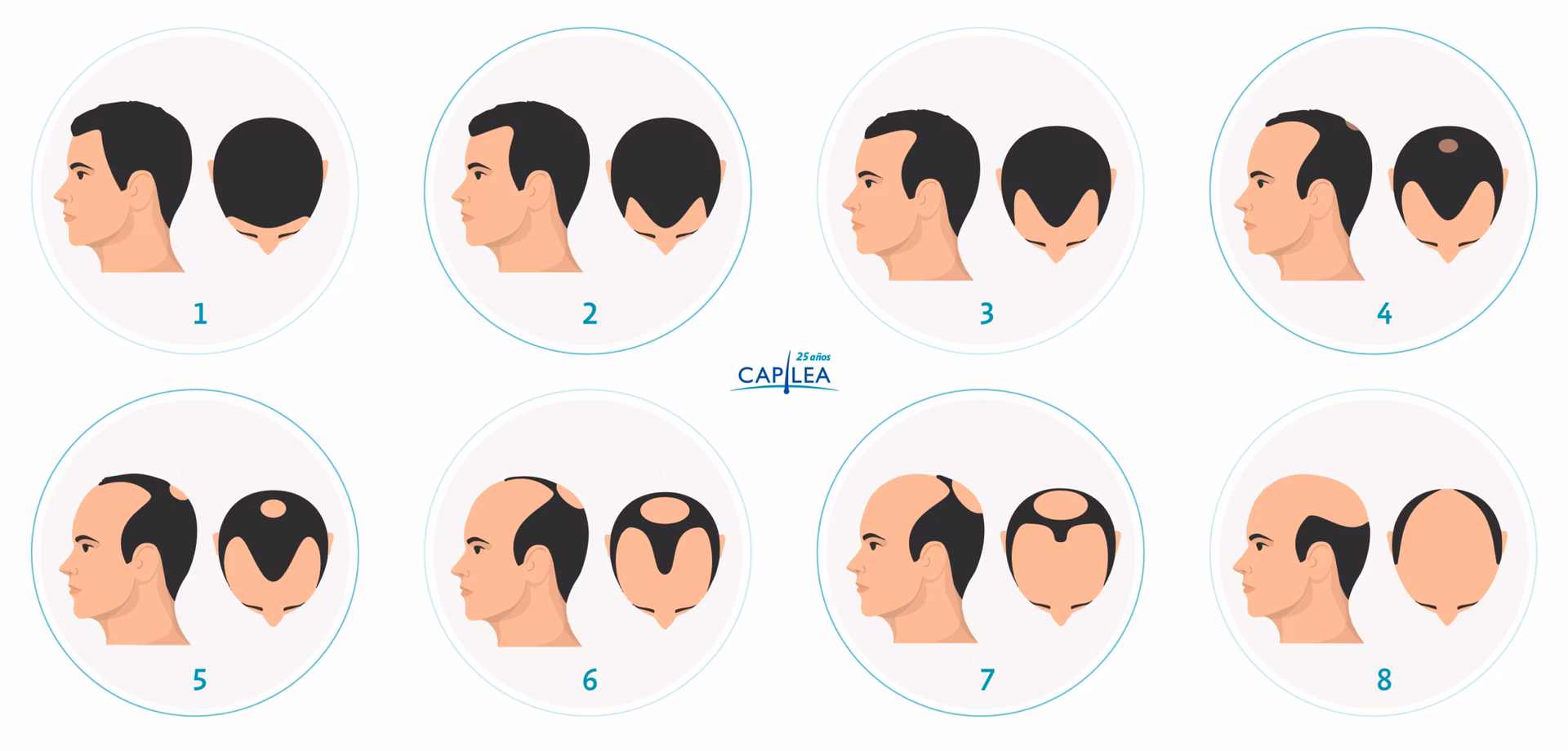 ¿Cómo saber si son entradas o calvicie?