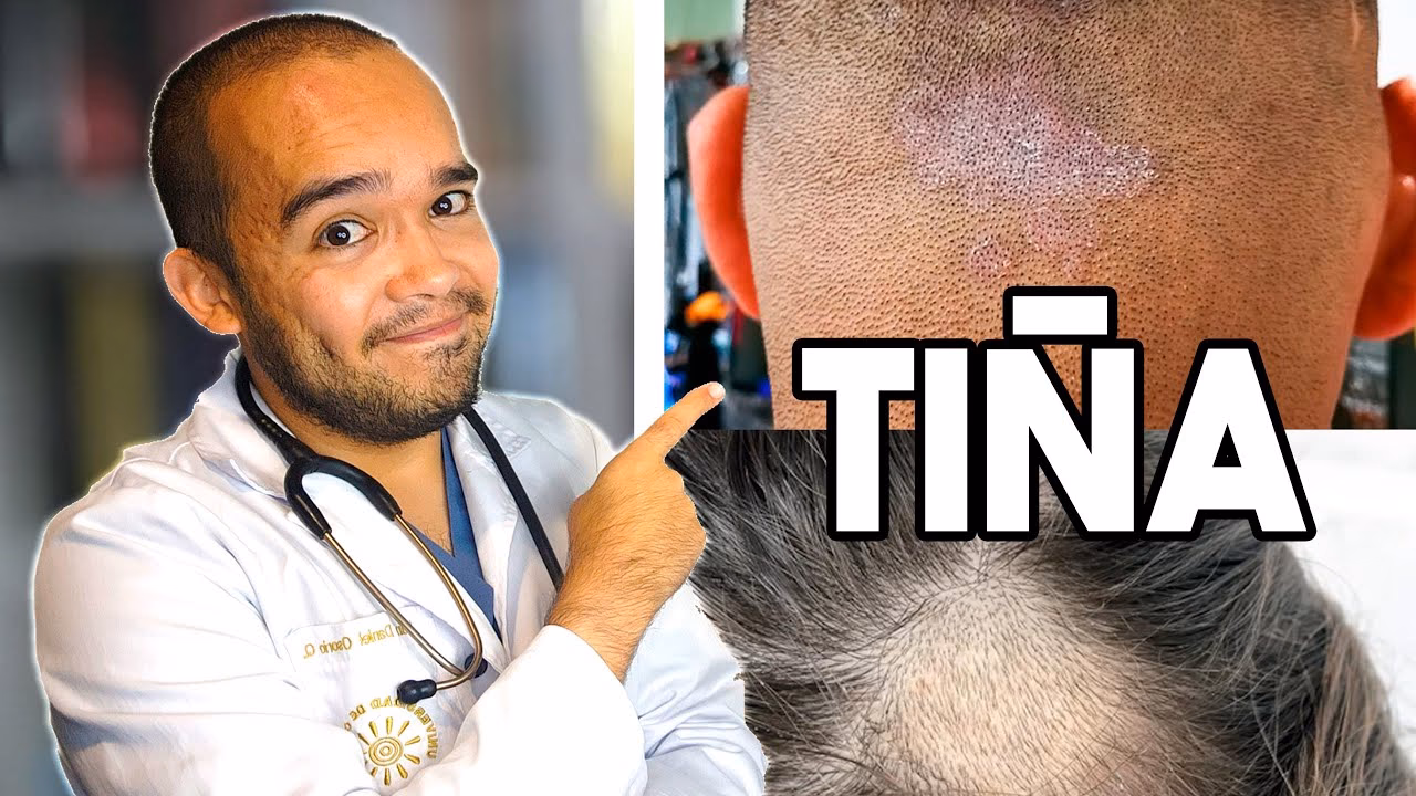 ¿Qué pasa si tengo hongos en el pelo?