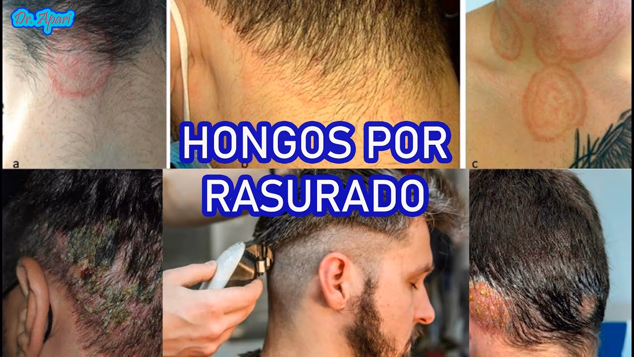 ¿El vinagre mata los hongos?