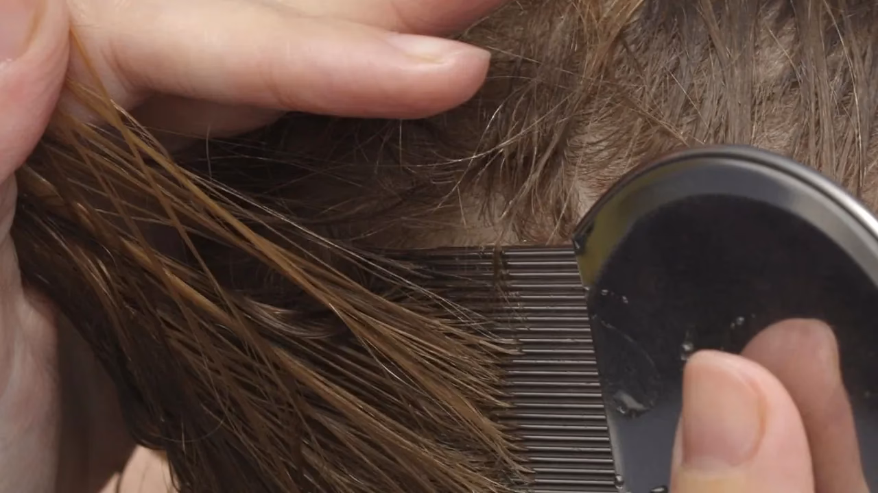 ¿Qué es mejor, vinagre blanco o de manzana para los piojos?