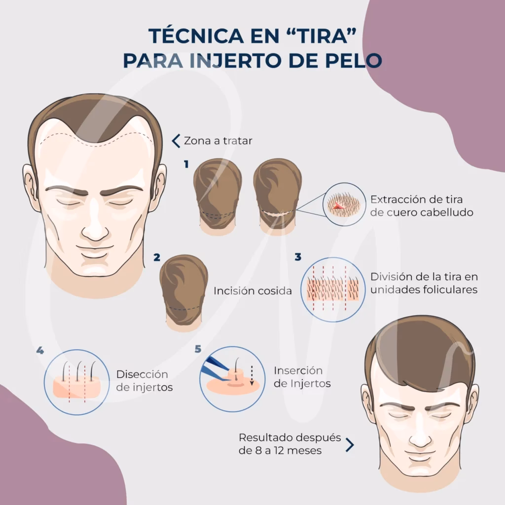¿Cómo se realiza el procedimiento de injerto de cabello?
