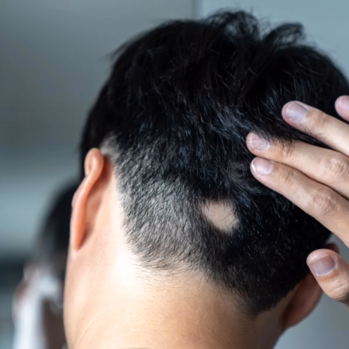 ¿Cómo se quita el hongo capilar del cabello?