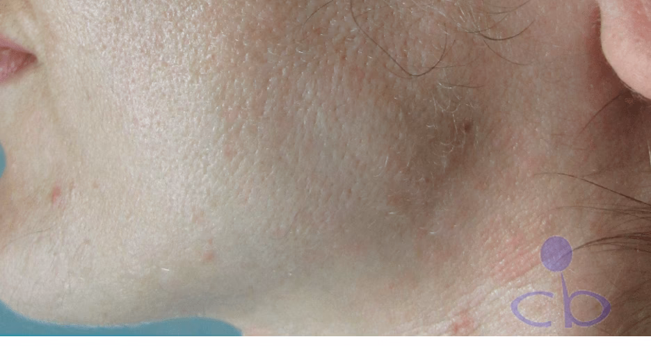 ¿Cómo se llama la raya de la barbilla?