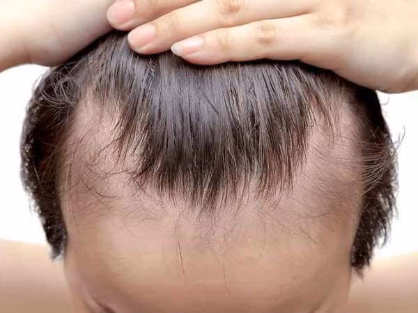 ¿Qué causa el cuero cabelludo con sebo?