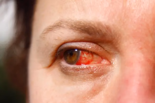 ¿Qué consecuencias traen las pestañas pelo a pelo?