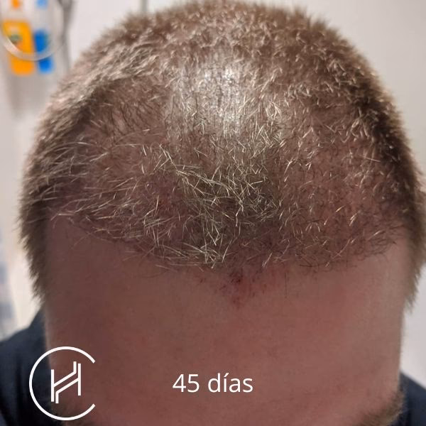 ¿Cuándo puedo cortarme el pelo en la zona donante?