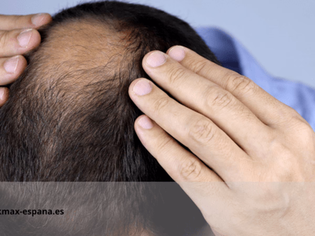 ¿Cómo arreglar una calva en la coronilla?