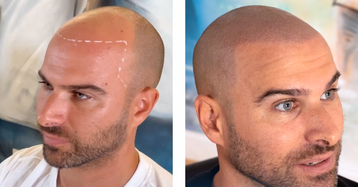 ¿Cuánto cuesta una pigmentación capilar?