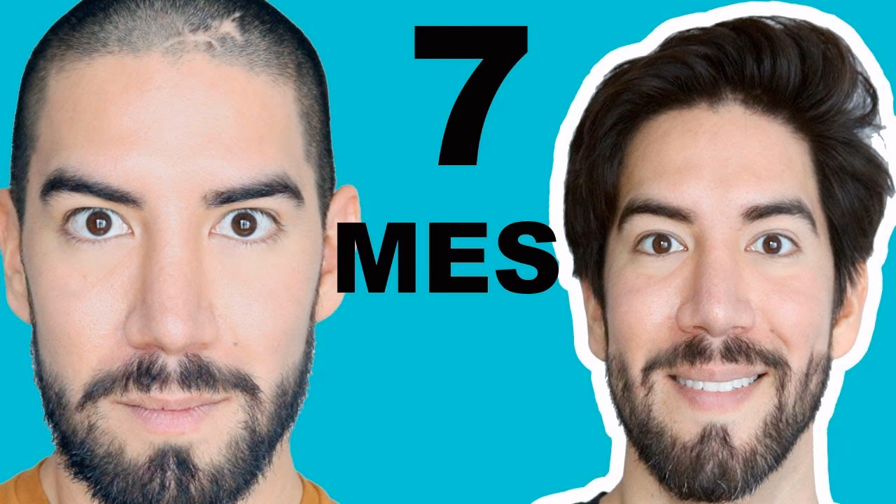 ¿Cuánto crece el pelo cada mes hombre?