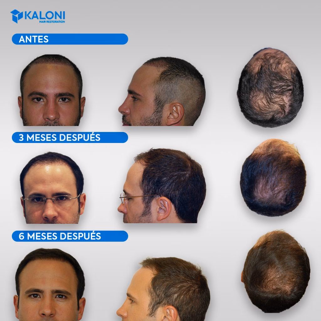 ¿Cuándo puedo empezar a usar minoxidil después de un injerto capilar?