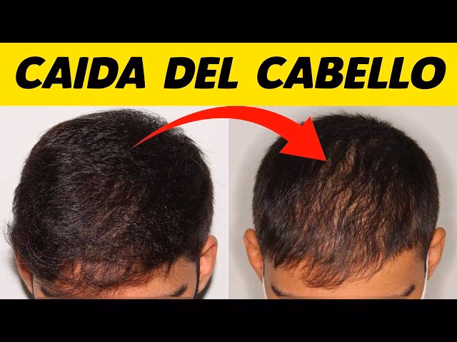 ¿Por qué se me cae el pelo cuando me paso la mano?