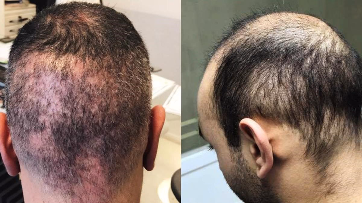 ¿Cuánto cuesta un trasplante de pelo en la República Dominicana?