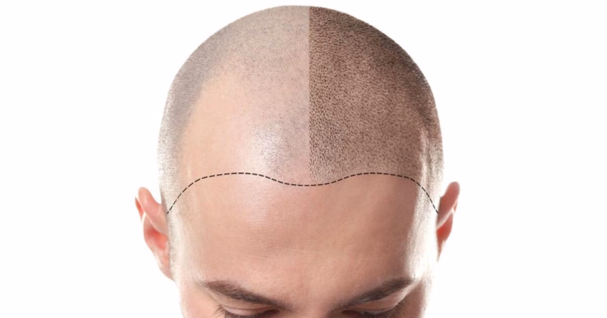 ¿Cuánto tiempo dura la micropigmentación del cuero cabelludo?