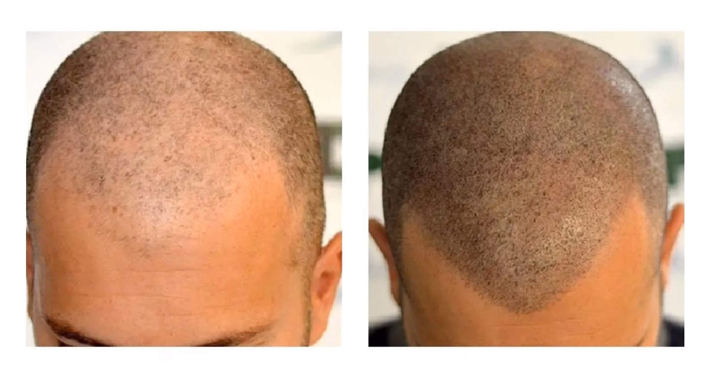 ¿Cuánto tiempo dura la micropigmentación del cuero cabelludo?