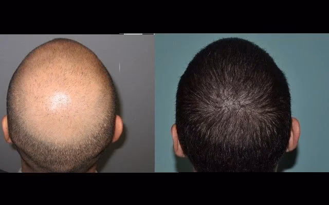 ¿Cuándo se empiezan a ver los resultados de un injerto?